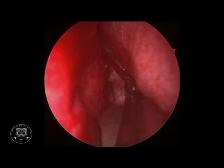 Resección endoscópica del adenoma hipofisario