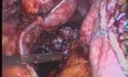 Conversión de la gastroplastia vertical con banda (VBG) a la gastrectomía en manga