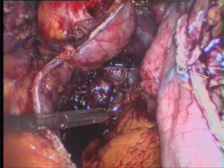 Conversión de la gastroplastia vertical con banda (VBG) a la gastrectomía en manga