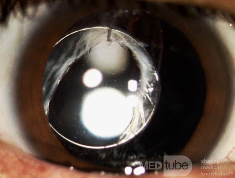 Subluxaci n de LIO de tres piezas Imagen MEDtube.es