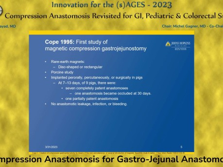 Anastomosis por compresión para anastomosis gastroyeyunal