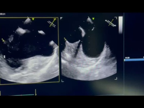 15. Caso de ecocardiografía - ¿Qué se ve?