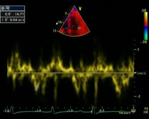 Miocardiopatía restrictiva