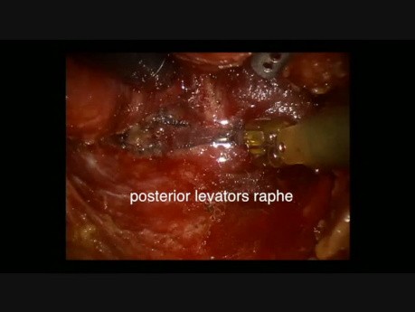 Resección abdominoperineal robótica - Modificación de resección abdominoperineal extraelevador (ELAPE)