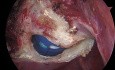Útero fibroide de gran tamaño - Histerectomía total laparoscópica