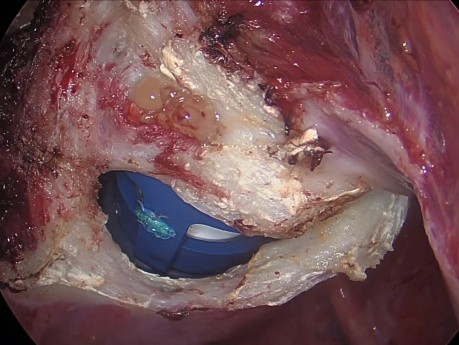 Útero fibroide de gran tamaño - Histerectomía total laparoscópica