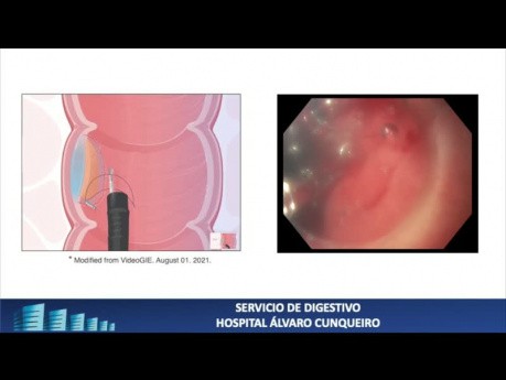 Disección submucosa endoscópica (DES) de una lesión gástrica. Uso de alambre de tracción.