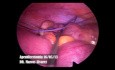Apendicectomía Laparoscopica - Técnica
