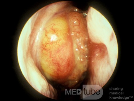 Papiloma invertido de cavidad nasal