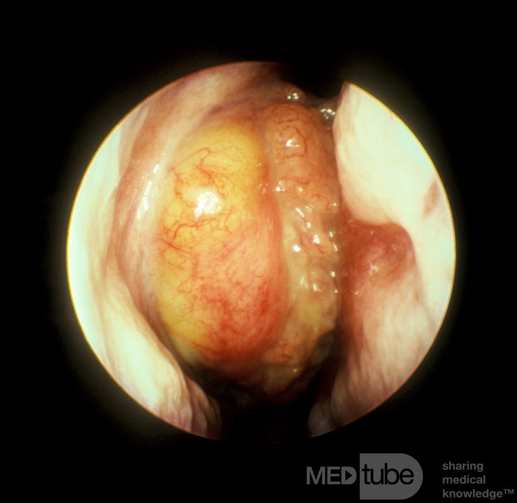 Papiloma invertido de cavidad nasal