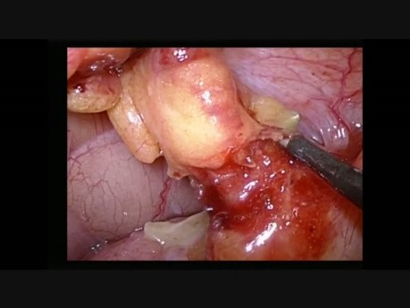 Apendicectomía laparoscópica en paciente con situs inversus