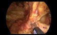 TAPP para la recurrencia de hernia después de TEP