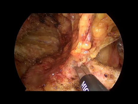 TAPP para la recurrencia de hernia después de TEP