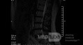Microdiscectomía Lumbar