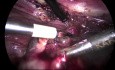 Cirugía laparoscópica de una quiste ovarico derecho Salpingooforectomía