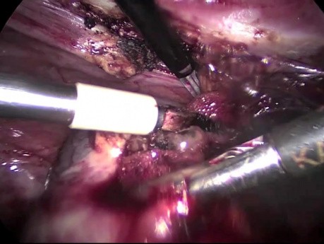 Cirugía laparoscópica de una quiste ovarico derecho Salpingooforectomía