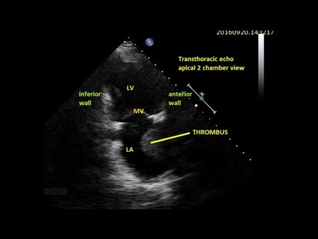 Un caso interesante de ecocardiografía - Vista apical de 2 cámaras