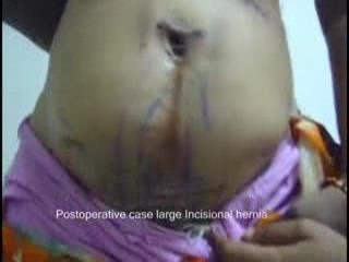 Hernia incisional grande - estado posoperatorio