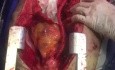 Revascularización visceral abdominal directa para la disección aórtica tipo B