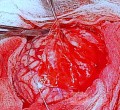 Craniectomía descompresiva en infarto maligno de la arteria cerebral media