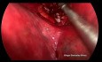 Segmentectomía S2 anatómica posterior superior derecha VATS uniportal no intubada