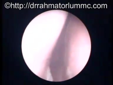 Visualización de la nasofaringe tras el tratamiento con radioterapia del carcinoma nasofaríngeo.