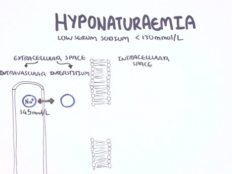 Hiponatremia - clasificación, causas, fisiopatología, tratamiento