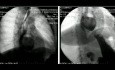 Resección toracoscópica de un gran divertículo esofágico medio adherido a la aorta y al hilio izquierdo del pulmón