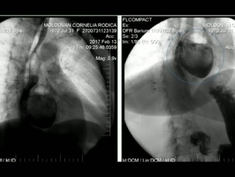 Resección toracoscópica de un gran divertículo esofágico medio adherido a la aorta y al hilio izquierdo del pulmón