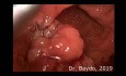 Cirugía Mínimamente Invasiva TransAnal (TAMIS) del adenoma velloso del recto