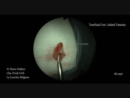 Septoplastia endoscópica mínimamente invasiva