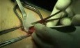 PHS (Prolene Hernia System): reparación indirecta de hernia