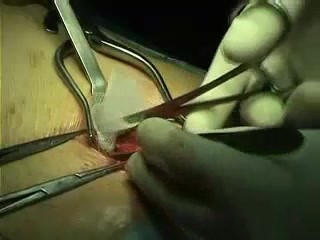 PHS (Prolene Hernia System): reparación indirecta de hernia