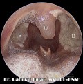Día 3 - Lecho de posamigdalectomía con edema de úvula