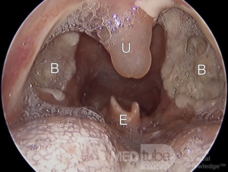 Día 3 - Lecho de posamigdalectomía con edema de úvula