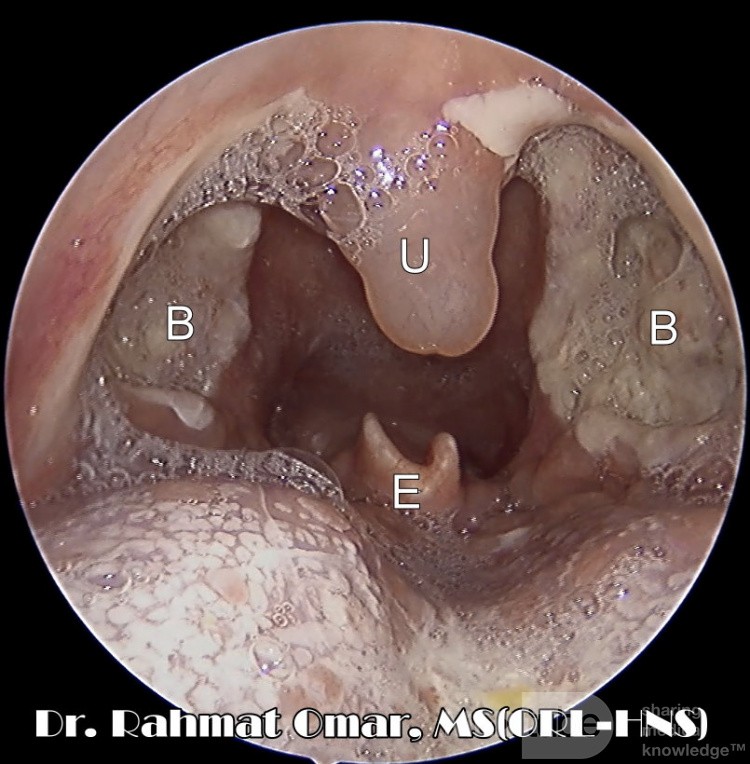Día 3 - Lecho de posamigdalectomía con edema de úvula