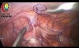 Apendicectomía laparoscópica mediante diatermia bipolar