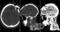 Estirpación de cavernoma subcortical 
