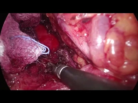Liberación laparoscópica del síndrome del ligamento arcuato medio (SLAM)