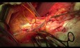 Operación citorreductora del cáncer de ovario. Parte pélvica.