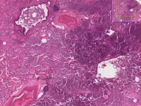 Bronconeumonía con microabscesos - cuadro clínico e histopatología