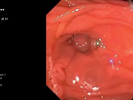 CPRE con gastroscopio para papila intradiverticular