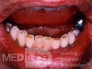 Abrasión dental