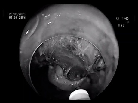 Disección submucosa endoscópica rectal LST-G (marzo de 2023)