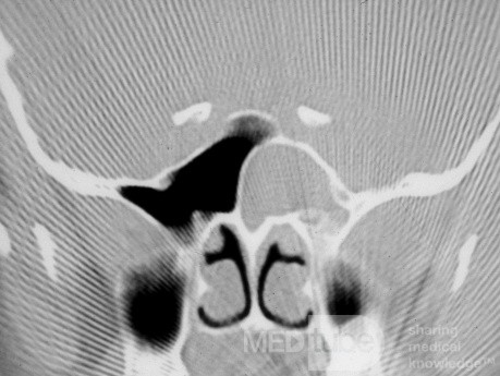 Mucocele del seno esfenoidal