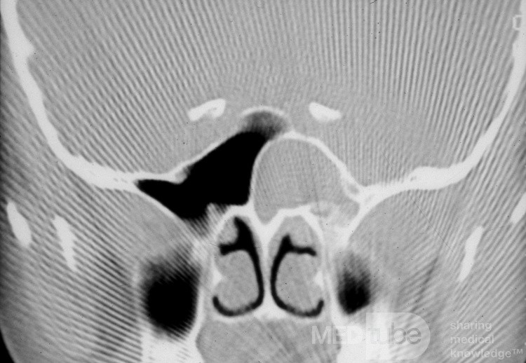 Mucocele del seno esfenoidal