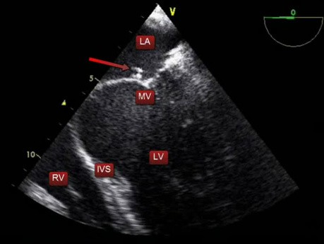 Ecocardiografía transesofágica (ETE) - endocarditis de la válvula mitral con una pequeña vegetación