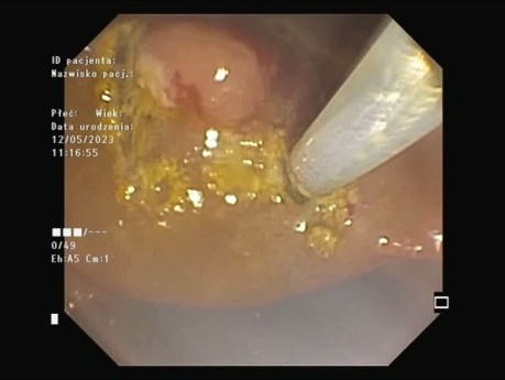 Resección de adenoma duodenal asistida con punta de lazo