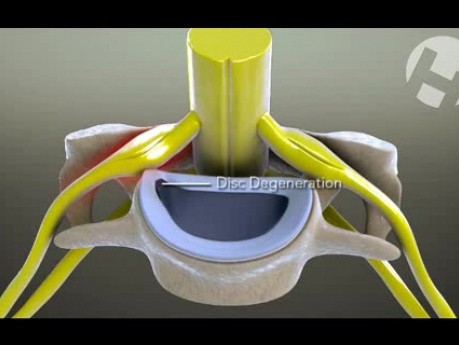 Radiculopatía cervical