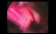 Laparoscopia. Salida. Perforación intestino delgado